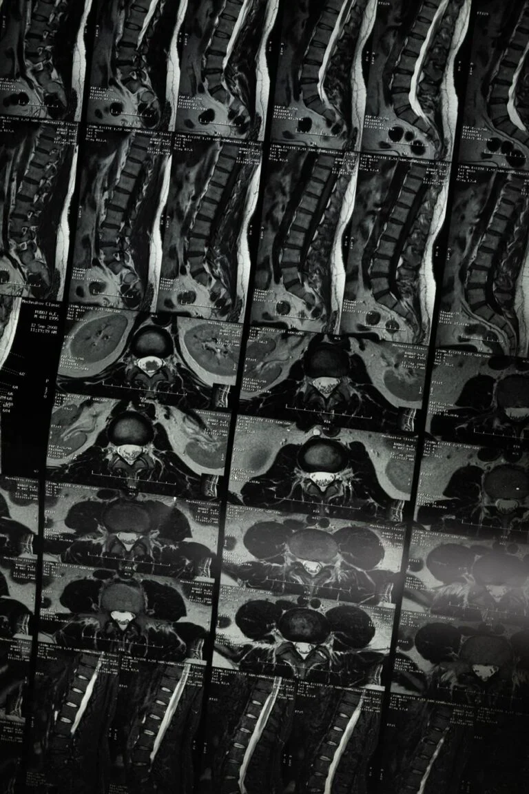 Spinal Cord Injuries lawyer in Georgia